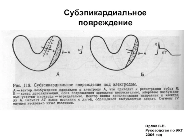 Орлов В.Н. Руководство по ЭКГ 2006 год Субэпикардиальное повреждение