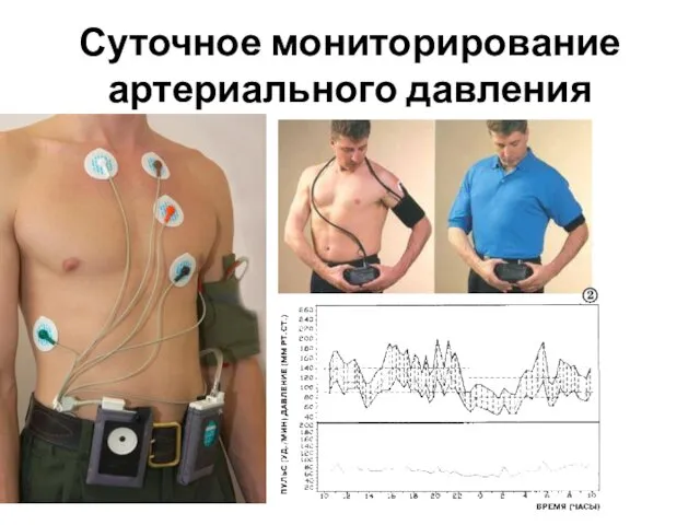 Суточное мониторирование артериального давления