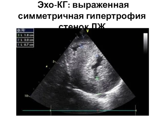 Эхо-КГ: выраженная симметричная гипертрофия стенок ЛЖ