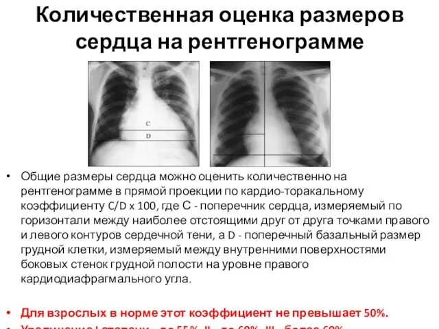 Количественная оценка размеров сердца на рентгенограмме Общие размеры сердца можно