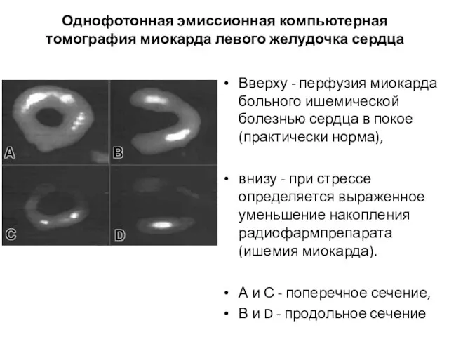 Однофотонная эмиссионная компьютерная томография миокарда левого желудочка сердца Вверху -