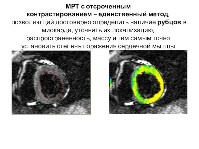 МРТ с отсроченным контрастированием – единственный метод, позволяющий достоверно определить