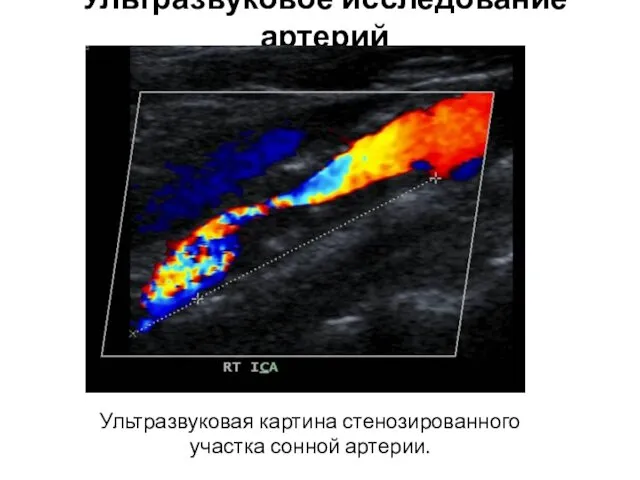 Ультразвуковое исследование артерий Ультразвуковая картина стенозированного участка сонной артерии.