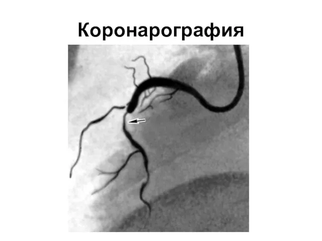 Коронарография