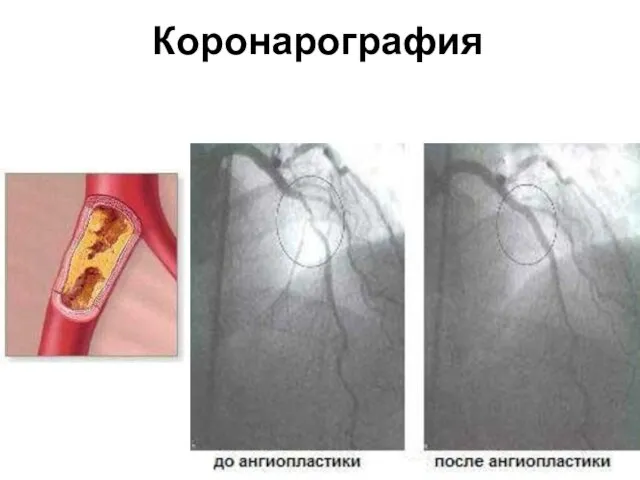 Коронарография