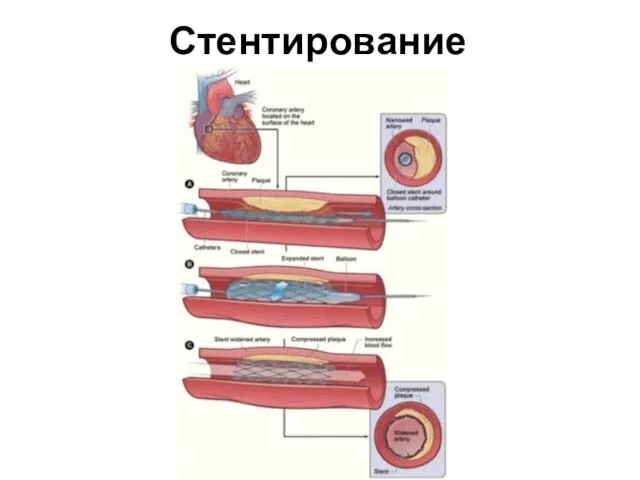 Стентирование