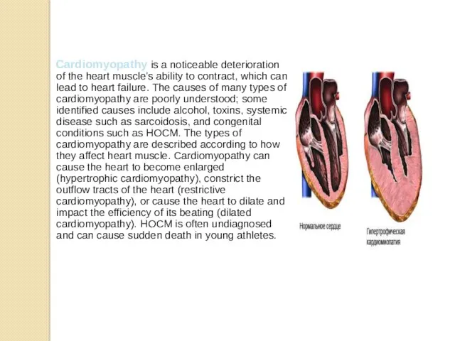 Cardiomyopathy is a noticeable deterioration of the heart muscle's ability