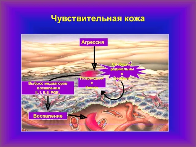 Чувствительная кожа Aгрессия Выброс медиаторов воспаления IL1, IL6, PGE2 Воспаление Повреждение Клеток Свободно-радикальные реакции