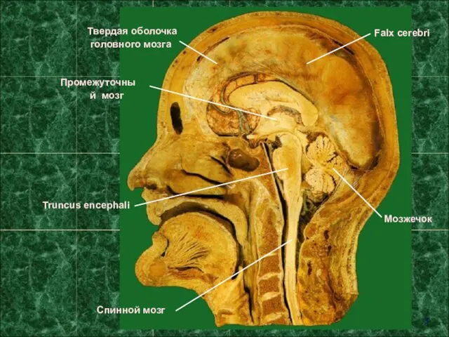 Промежуточный мозг Truncus encephali Мозжечок Falx cerebri Твердая оболочка головного мозга Спинной мозг 3