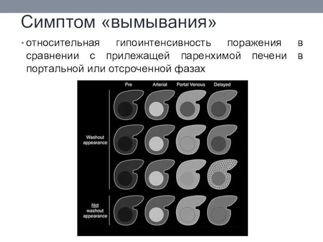 Симптом «вымывания» относительная гипоинтенсивность поражения в сравнении с прилежащей паренхимой печени в портальной или отсроченной фазах