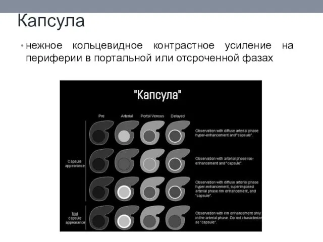 Капсула нежное кольцевидное контрастное усиление на периферии в портальной или отсроченной фазах