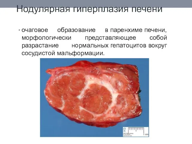 Нодулярная гиперплазия печени очаговое образование в паренхиме печени, морфологически представляющее