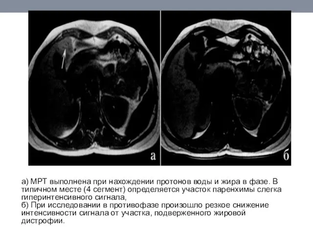 а) МРТ выполнена при нахождении протонов воды и жира в