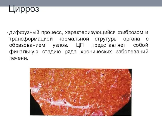 Цирроз диффузный процесс, характеризующийся фиброзом и трансформацией нормальной струтуры органа