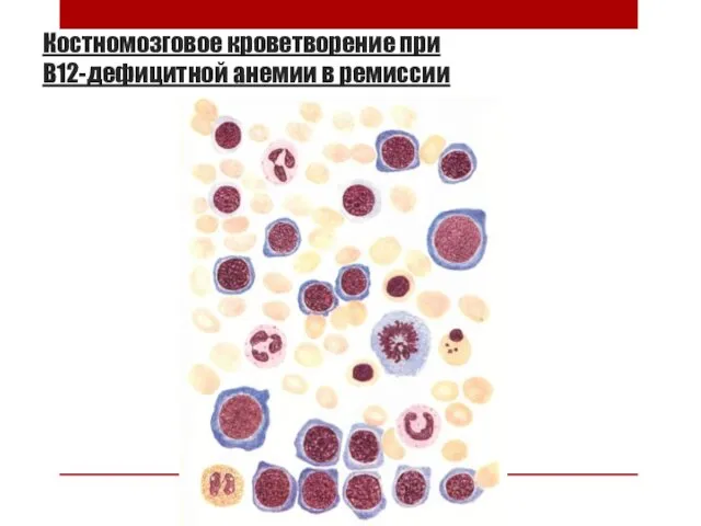 Костномозговое кроветворение при В12-дефицитной анемии в ремиссии