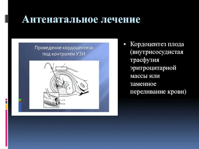 Антенатальное лечение Кордоцентез плода (внутрисосудистая трасфузия эритроцитарной массы или заменное переливание крови)