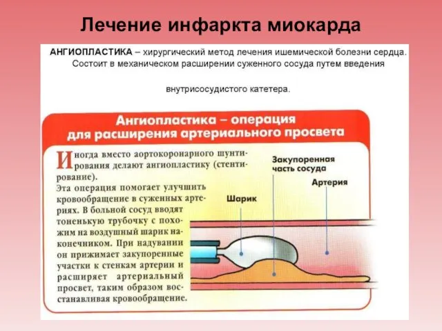 Лечение инфаркта миокарда