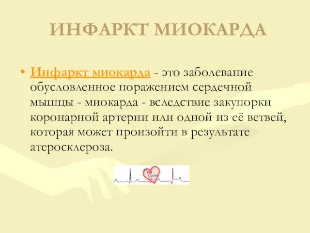 ИНФАРКТ МИОКАРДА Инфаркт миокарда - это заболевание обусловленное поражением сердечной