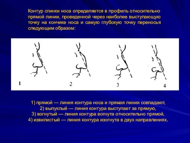 Контур спинки носа определяется в профиль относительно прямой линии, проведенной