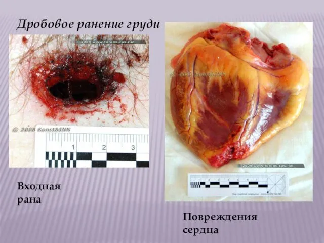 Дробовое ранение груди Входная рана Повреждения сердца