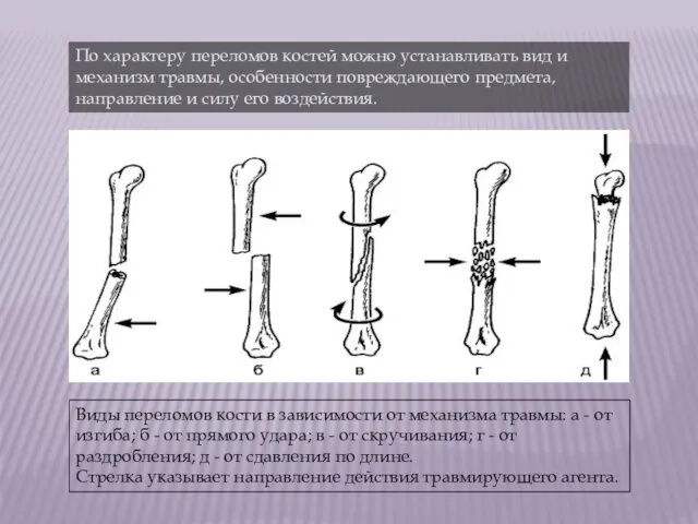 По характеру переломов костей можно устанавливать вид и механизм травмы,