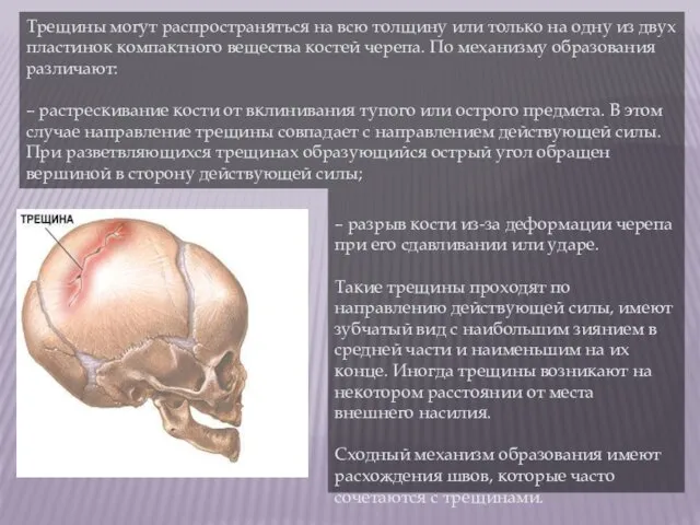 – разрыв кости из-за деформации черепа при его сдавливании или