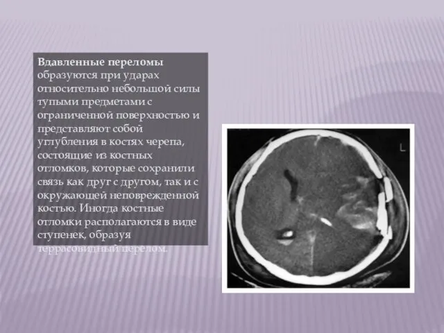 Вдавленные переломы образуются при ударах относительно небольшой силы тупыми предметами