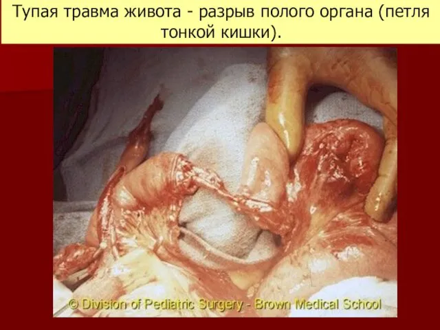 Тупая травма живота - разрыв полого органа (петля тонкой кишки).