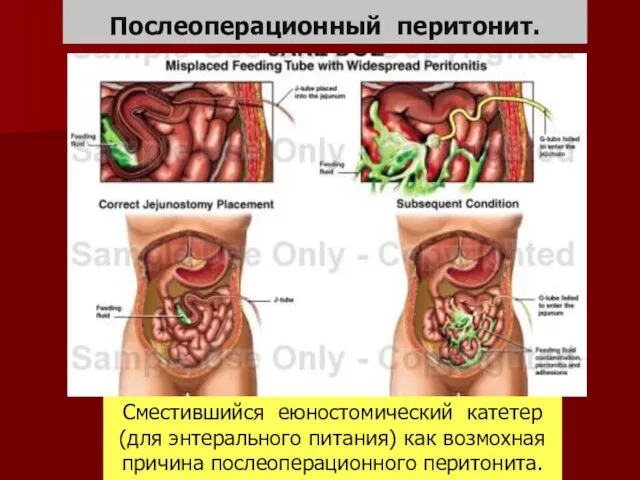 Послеоперационный перитонит. Сместившийся еюностомический катетер (для энтерального питания) как возмохная причина послеоперационного перитонита.