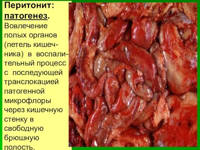 Перитонит: патогенез. Вовлечение полых органов (петель кишеч-ника) в воспали-тельный процесс