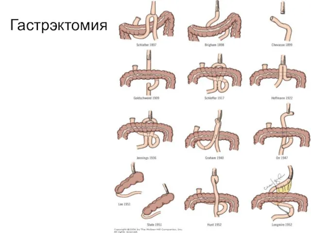 Гастрэктомия