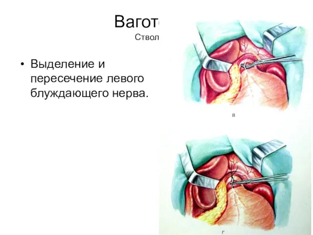 Ваготомия Стволовая Выделение и пересечение левого блуждающего нерва.