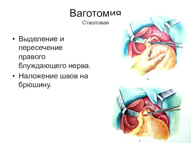 Ваготомия Стволовая Выделение и пересечение правого блуждающего нерва. Наложение швов на брюшину.