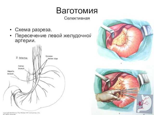 Ваготомия Селективная Схема разреза. Пересечение левой желудочной артерии.
