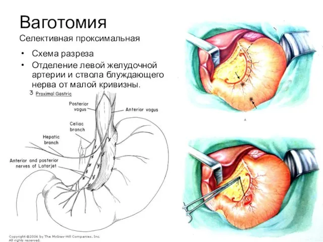 Ваготомия Селективная проксимальная Схема разреза Отделение левой желудочной артерии и ствола блуждающего нерва от малой кривизны.