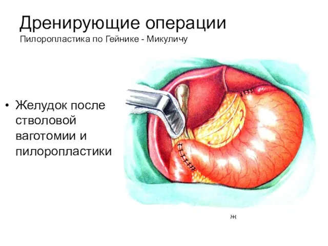 Дренирующие операции Пилоропластика по Гейнике - Микуличу Желудок после стволовой ваготомии и пилоропластики