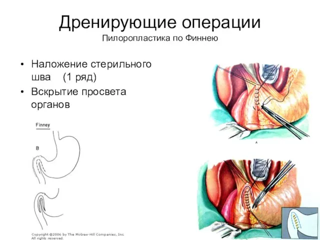 Дренирующие операции Пилоропластика по Финнею Наложение стерильного шва (1 ряд) Вскрытие просвета органов