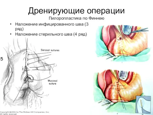 Дренирующие операции Пилоропластика по Финнею Наложение инфицированного шва (3 ряд) Наложение стерильного шва (4 ряд)