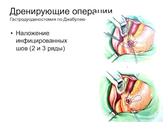 Дренирующие операции Гастродуоденостомия по Джабулею Наложение инфицированных шов (2 и 3 ряды)