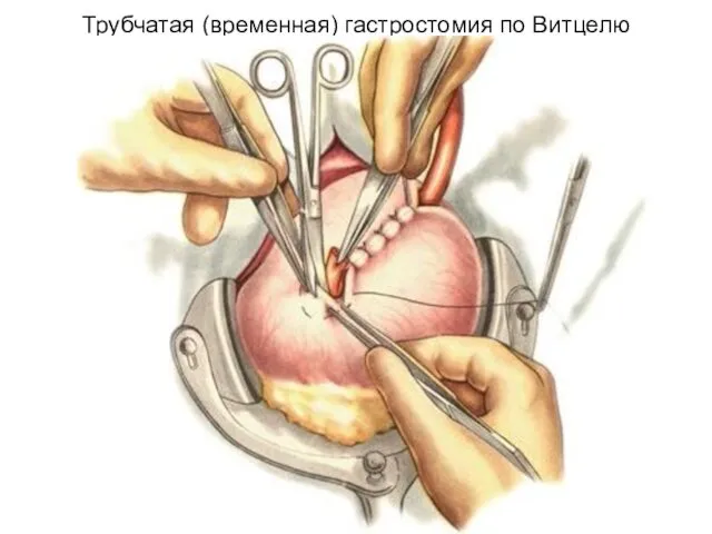 Трубчатая (временная) гастростомия по Витцелю