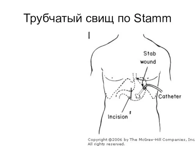 Трубчатый свищ по Stamm