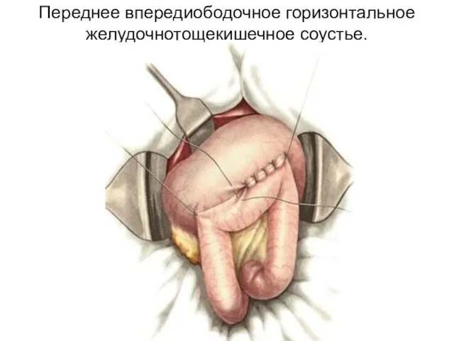 Переднее впередиободочное горизонтальное желудочнотощекишечное соустье.