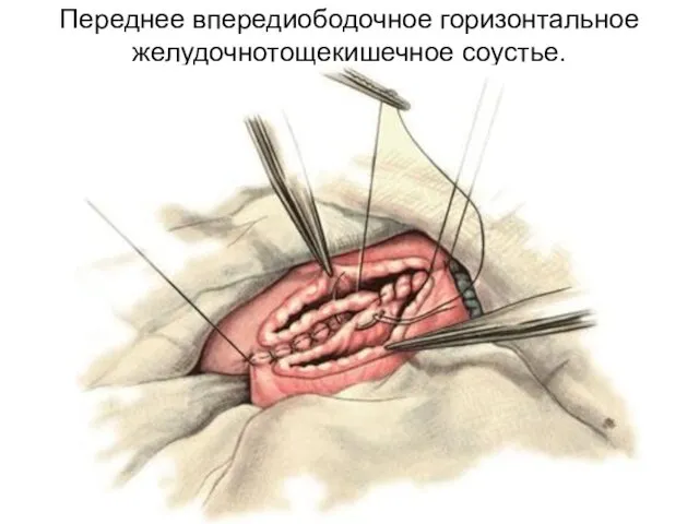 Переднее впередиободочное горизонтальное желудочнотощекишечное соустье.