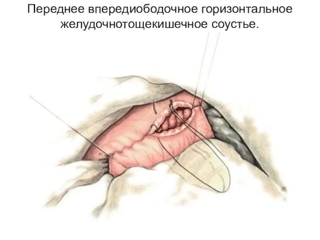 Переднее впередиободочное горизонтальное желудочнотощекишечное соустье.