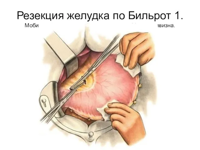 Резекция желудка по Бильрот 1. Мобилизация удаляемой части желудка. Малая кривизна.