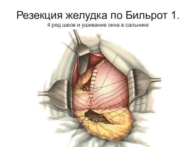 Резекция желудка по Бильрот 1. 4 ряд швов и ушивание окна в сальнике