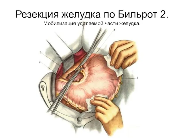 Резекция желудка по Бильрот 2. Мобилизация удаляемой части желудка.