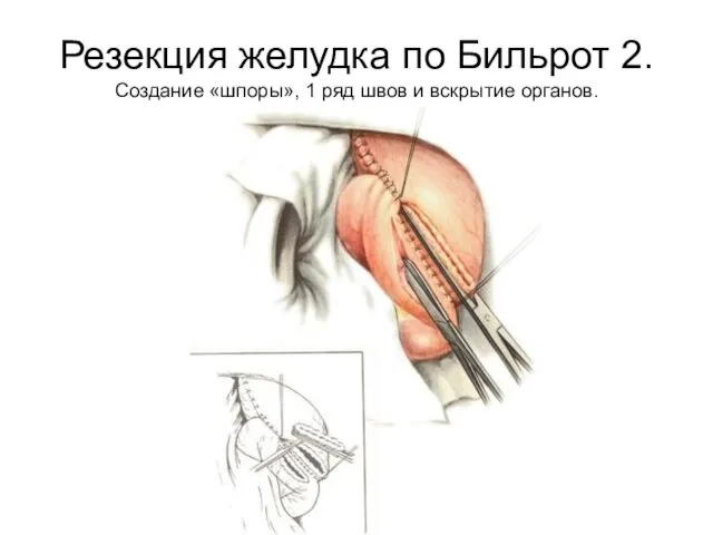 Резекция желудка по Бильрот 2. Создание «шпоры», 1 ряд швов и вскрытие органов.
