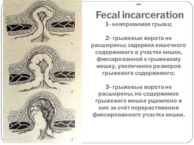 Каловое ущемление – Fecal incarceration 1- невправимая грыжа; 2- грыжевые