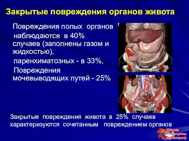 Закрытые повреждения органов живота Повреждения полых органов наблюдаются в 40%